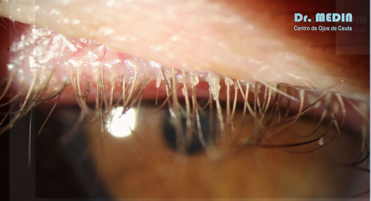 blefaritis por demodex