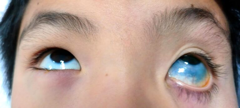 ¿Qué significan los cambios de color en la parte blanca de tus ojos?