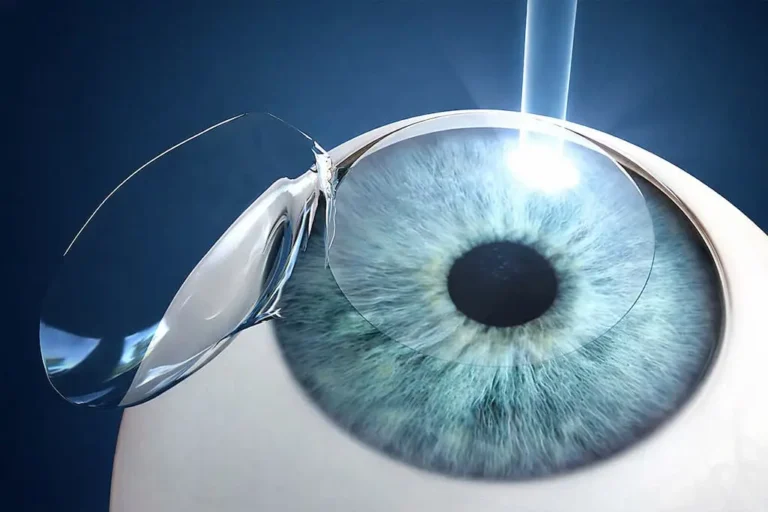 ojo seco lasik