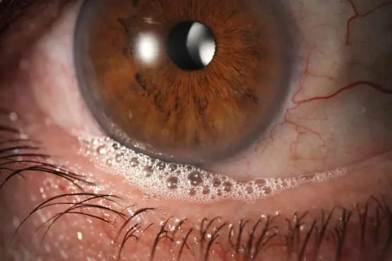 ojo seco dgm