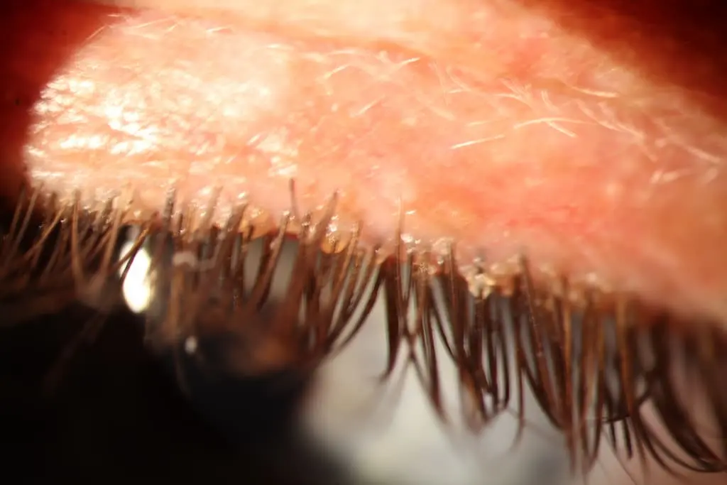 demodex | Oftalmoceuta - Centro de Ojos de Ceuta · Dr. Medín filename sep oftalmoceuta